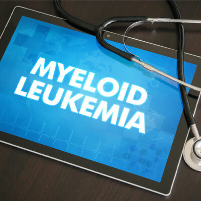 5 signs that indicate myeloid leukemia