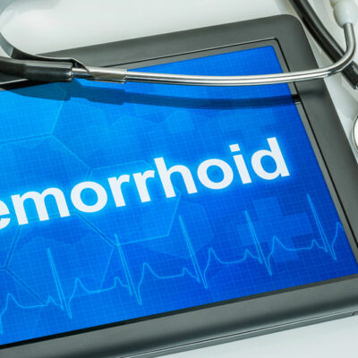 8 Ways to Treat Hemorrhoids