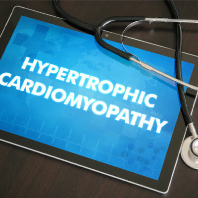 Everything to know about obstructive hypertrophic cardiomyopathy