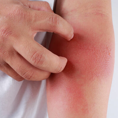 Follow this diet to manage eczema symptoms