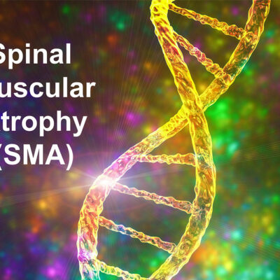 Spinal muscular atrophy &#8211; causes, symptoms and physical therapies