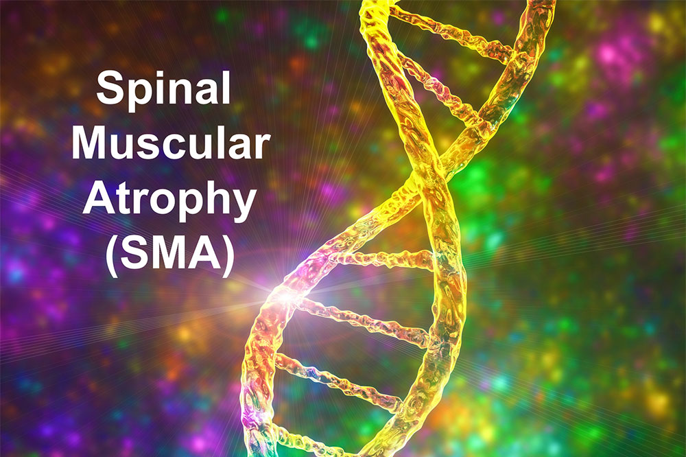 Spinal muscular atrophy &#8211; causes, symptoms and physical therapies