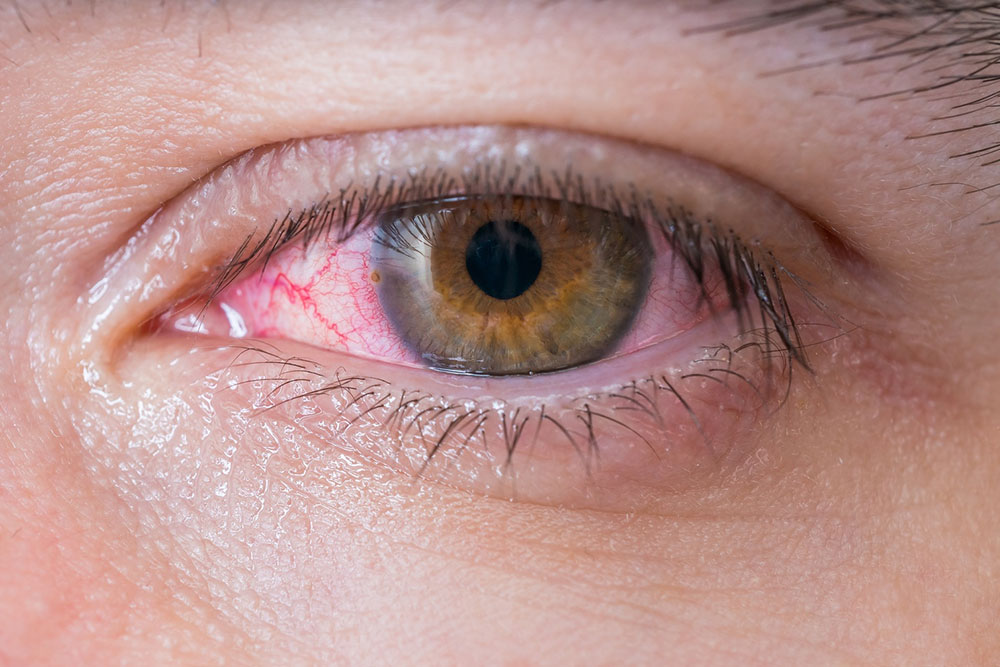 Red Eyes &#8211; Common Symptoms, Causes, and Treatment